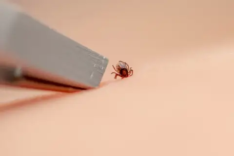 Zbliżenie na kleszcza na skórze obok metalowego narzędzia.